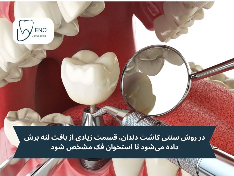 در روش سنتی کاشت دندان، قسمت زیادی از بافت لثه برش داده میشود تا استخوان فک مشخص شود