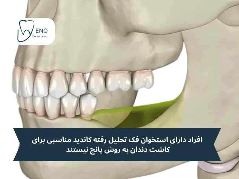 افراد دارای استخوان فک تحلیل رفته کاندید مناسبی برای کاشت دندان به روش پانچ نیستند