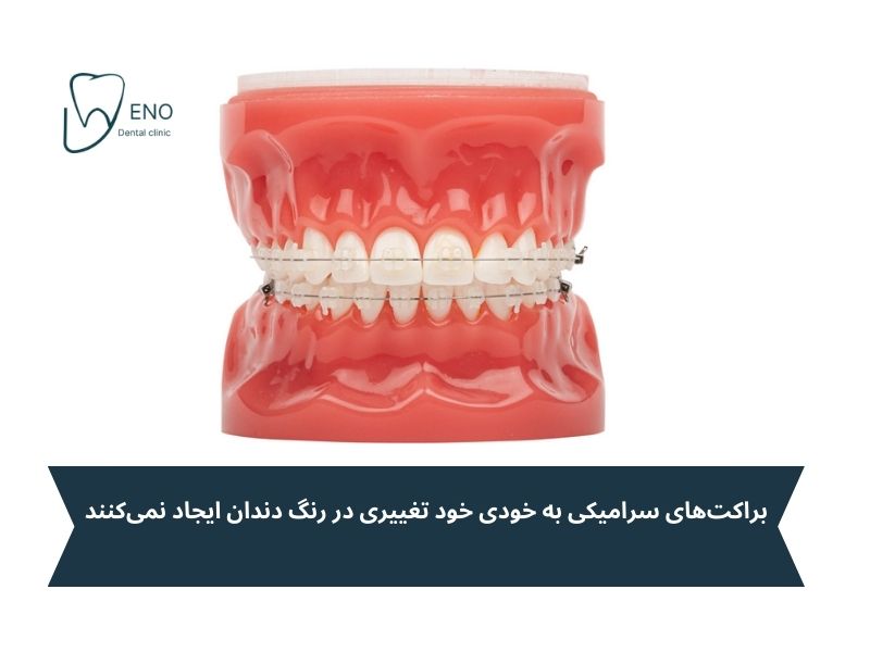 آیا ارتودنسی سرامیکی باعث سفید شدن یا زرد شدن دندانها میشود