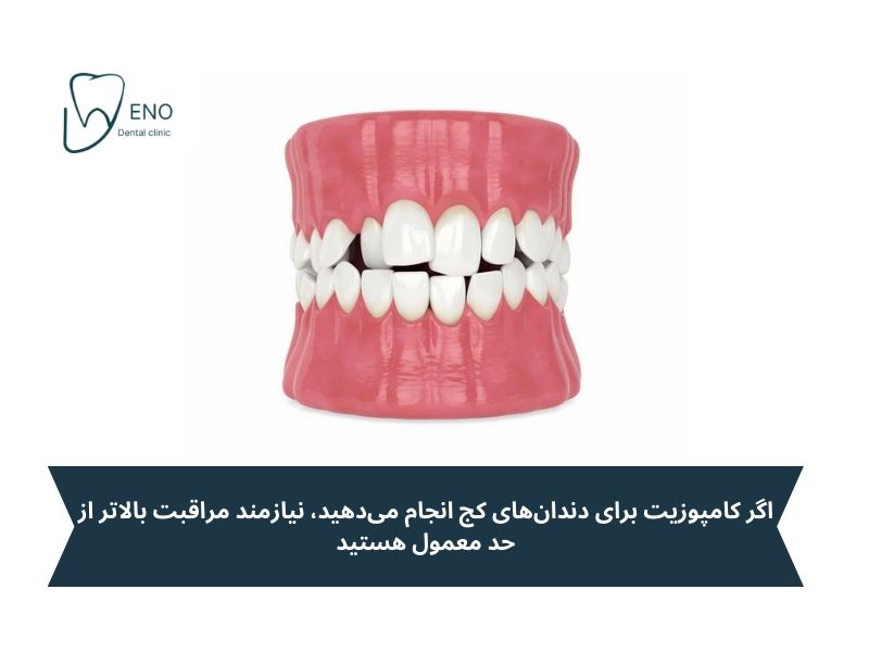 آیا کامپوزیت باعث پوسیدگی دندان میشود