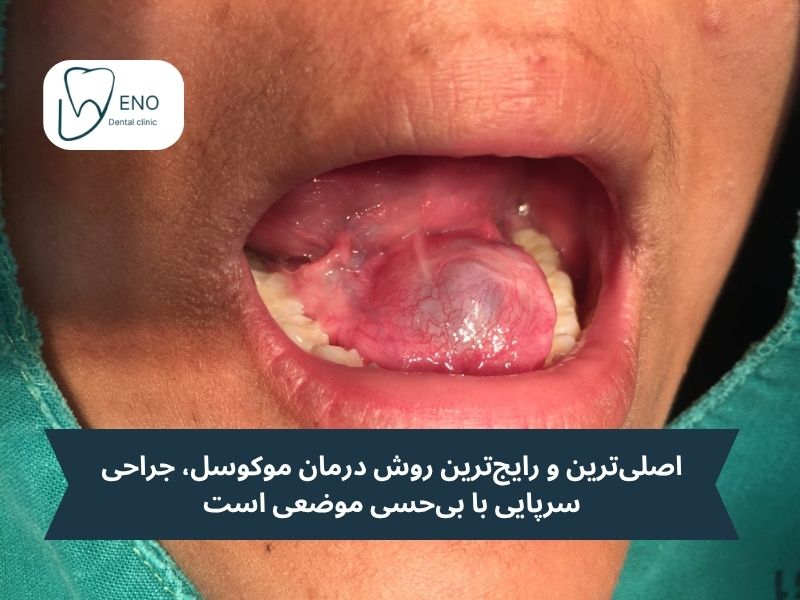 جراحی موکوسل دهان