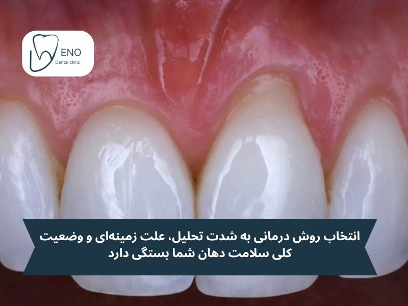 راههای درمان تحلیل لثه؛ از کنترل تا بازسازی