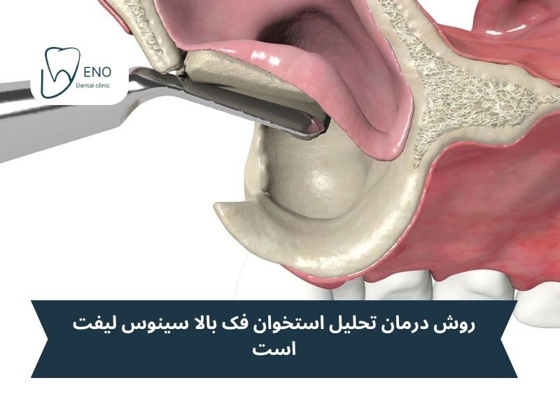 روش درمان تحلیل استخوان فک بالا