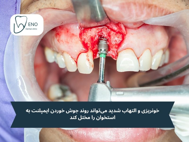 شکست ایمپلنت