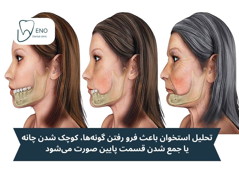 علائم تحلیل استخوان فک