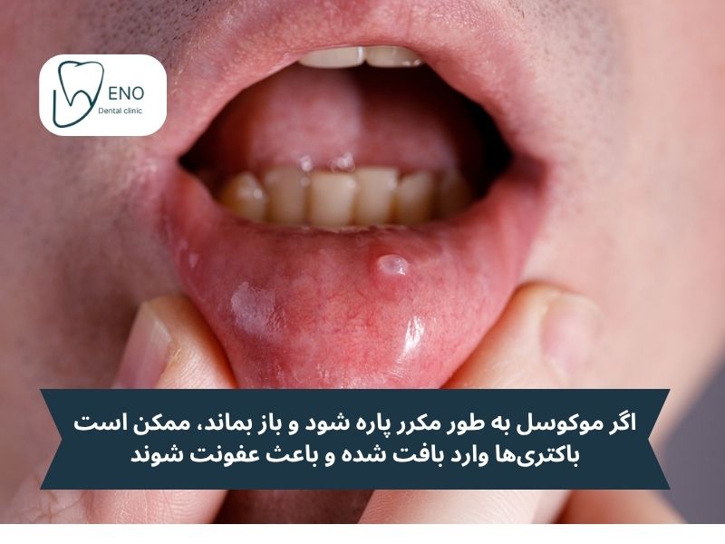 عوارض موکوسل دهان