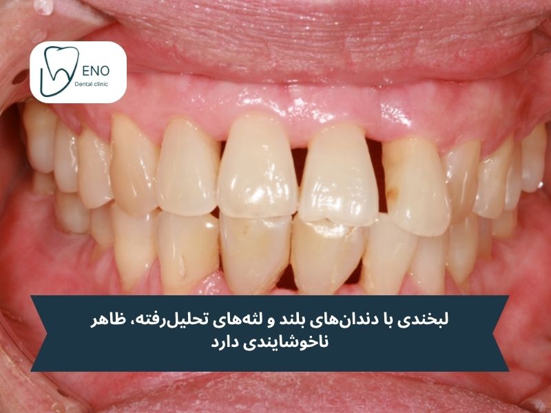 عوارض نادیده گرفتن تحلیل لثه؛ هزینهای سنگینتر از درمان