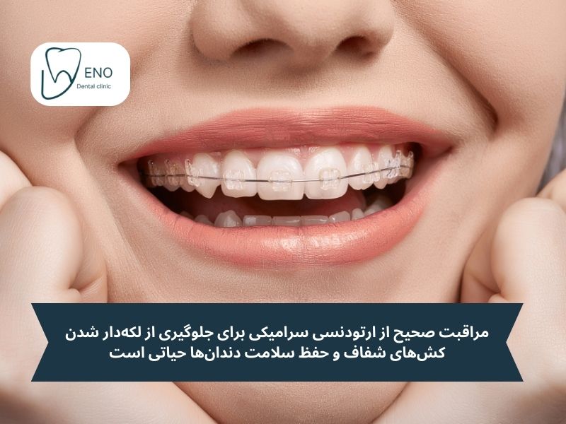 مراقبت از براکتهای سرامیکی؛ راهنمای حفظ شفافیت و سلامت