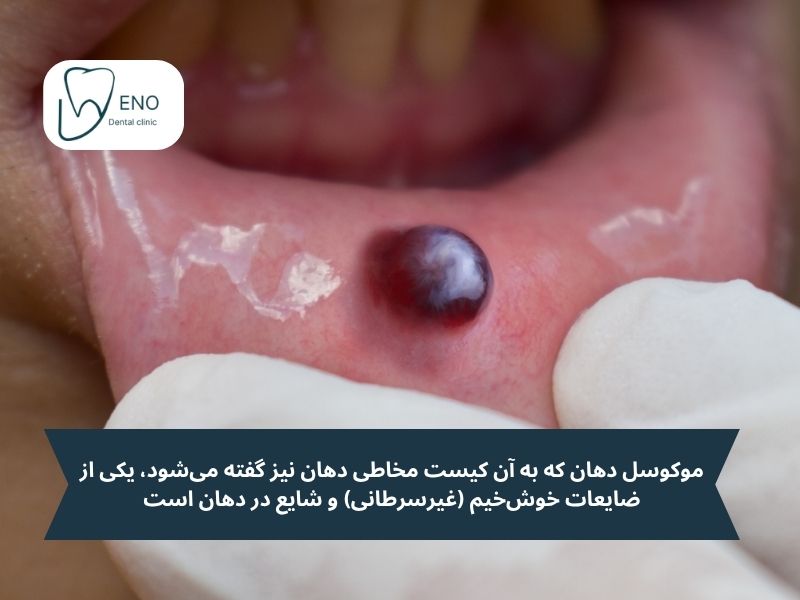 موکوسل دهان چیست