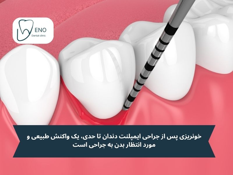 چرا خونریزی بعد از ایمپلنت رخ میدهد