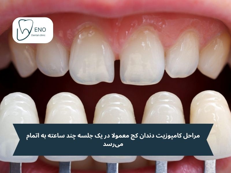 کامپوزیت برای دندان های کج چگونه انجام میشود