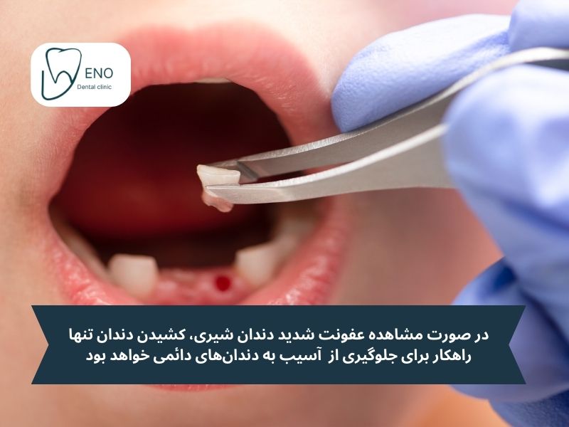 در صورت مشاهده عفونت شدید دندان شیری، کشیدن دندان تنها راهکار برای جلوگیری از آسیب به دندانهای دائمی خواهد بود