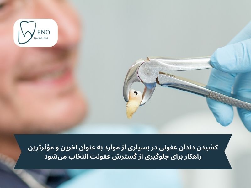 کشیدن دندان عفونی در بسیاری از موارد به عنوان آخرین و مؤثرترین راهکار برای جلوگیری از گسترش عفونت انتخاب میشود