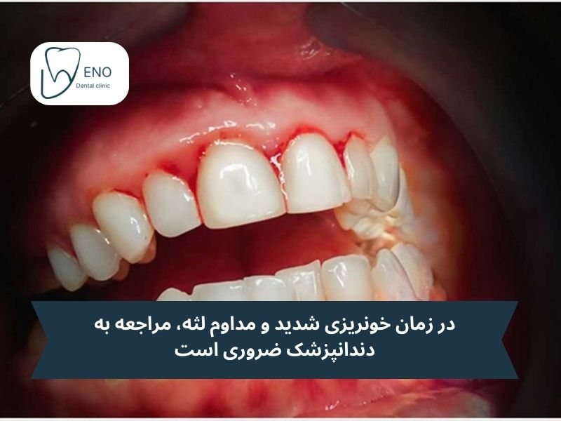 مزاجعه به دندانپزشک برای خونریزی لثه