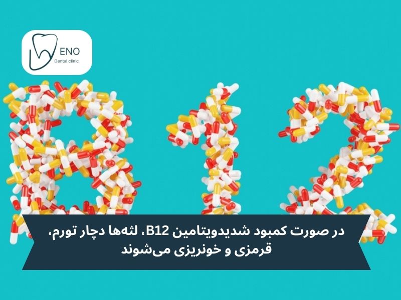 کمبود ویتامین B12 و خونریزی لثه