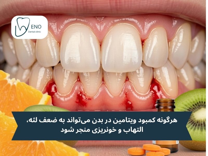 کمبود چه ویتامینی باعث خونریزی لثه میشود
